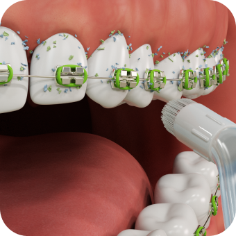 ilustração do aparelho Clearpik sendo utilizado nos dentes de uma boca com aparelho dental